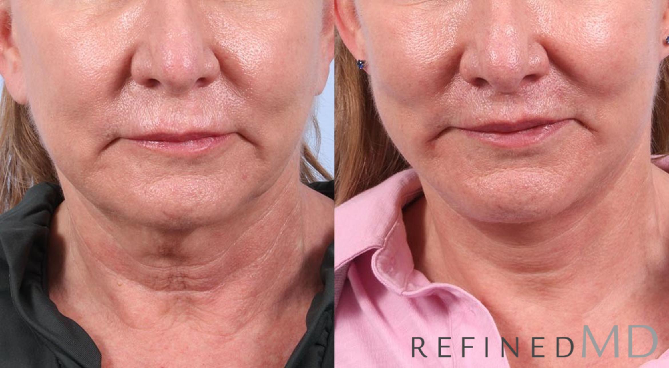 Before & After Facelift Case 1012 View 1 View in Los Gatos & San Jose, CA