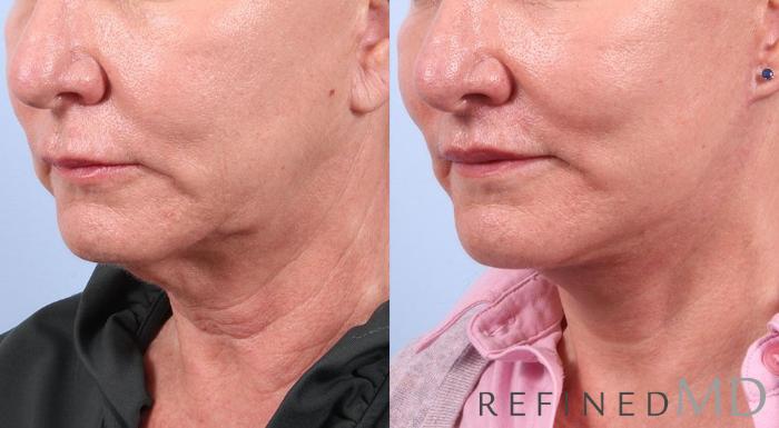 Before & After Facelift Case 1012 View 2 View in Los Gatos & San Jose, CA