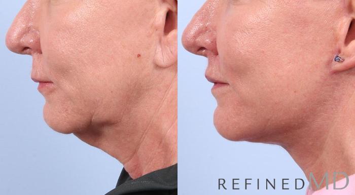 Before & After Facelift Case 1012 View 3 View in Los Gatos & San Jose, CA