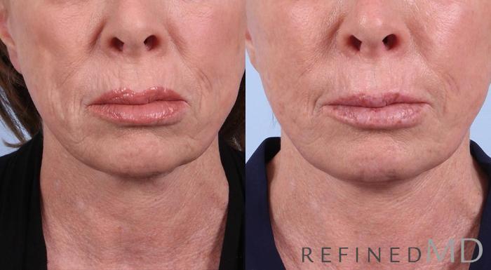 Before & After Facelift Case 1013 View 1 View in Los Gatos & San Jose, CA