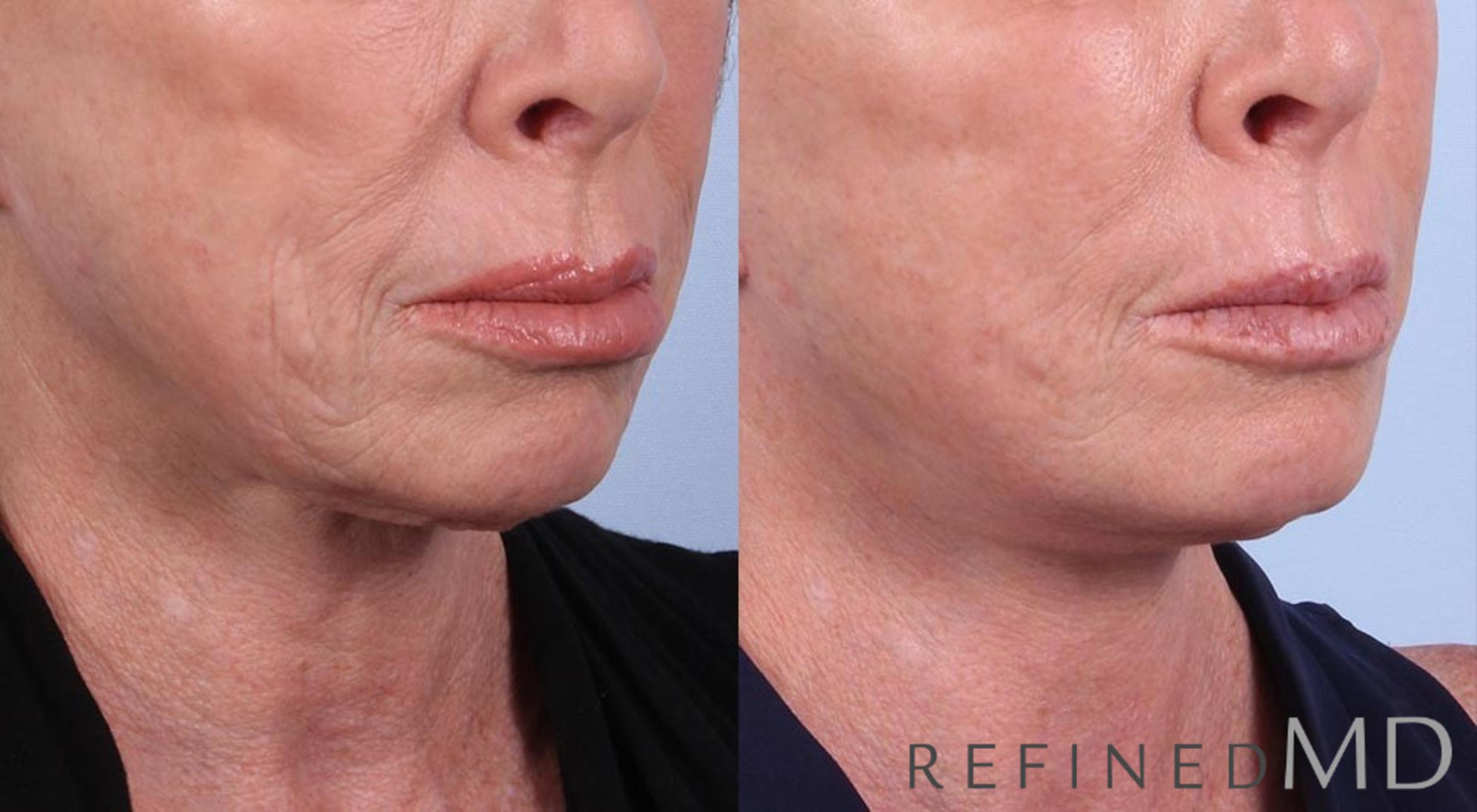Before & After Facelift Case 1013 View 2 View in Los Gatos & San Jose, CA