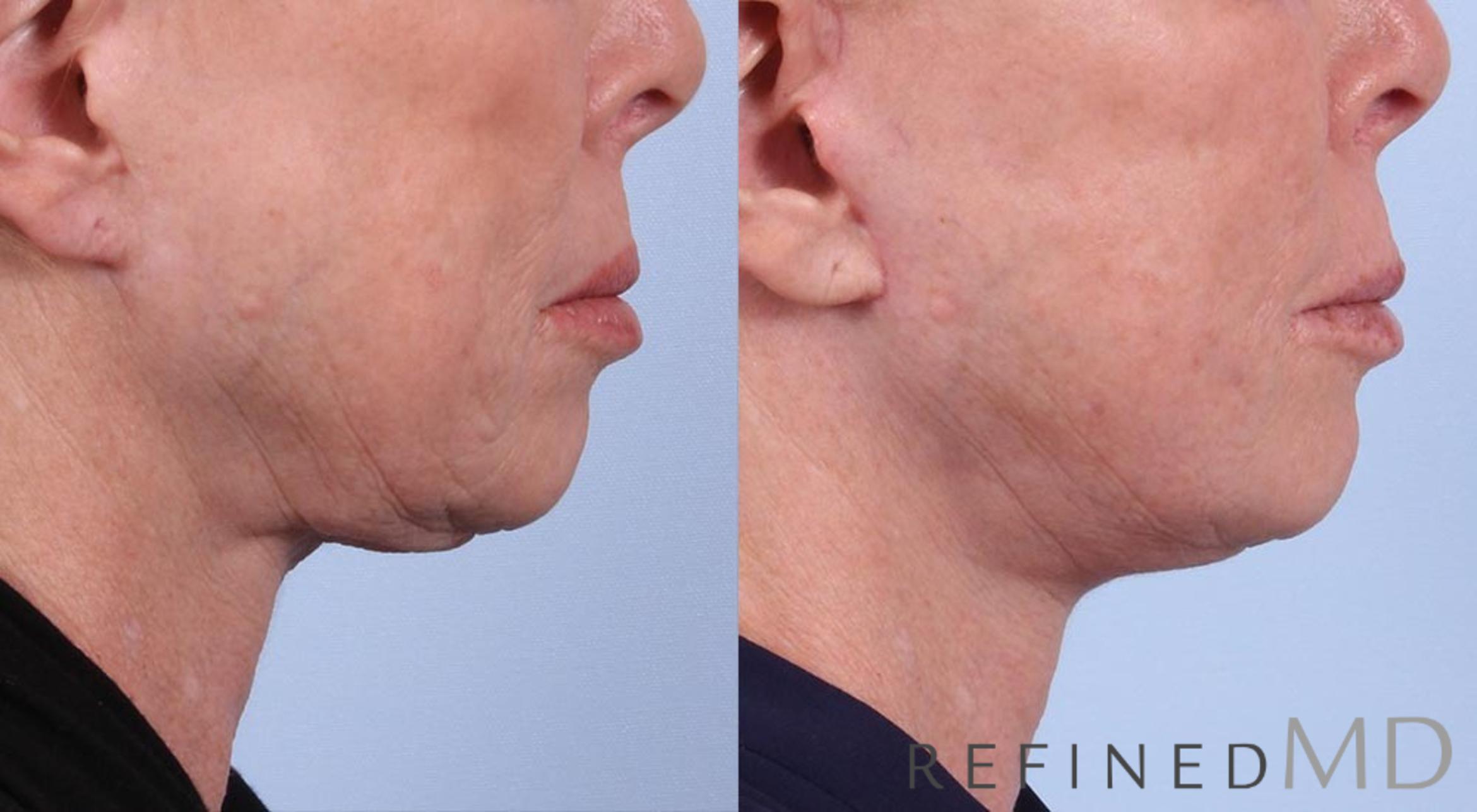 Before & After Facelift Case 1013 View 3 View in Los Gatos & San Jose, CA