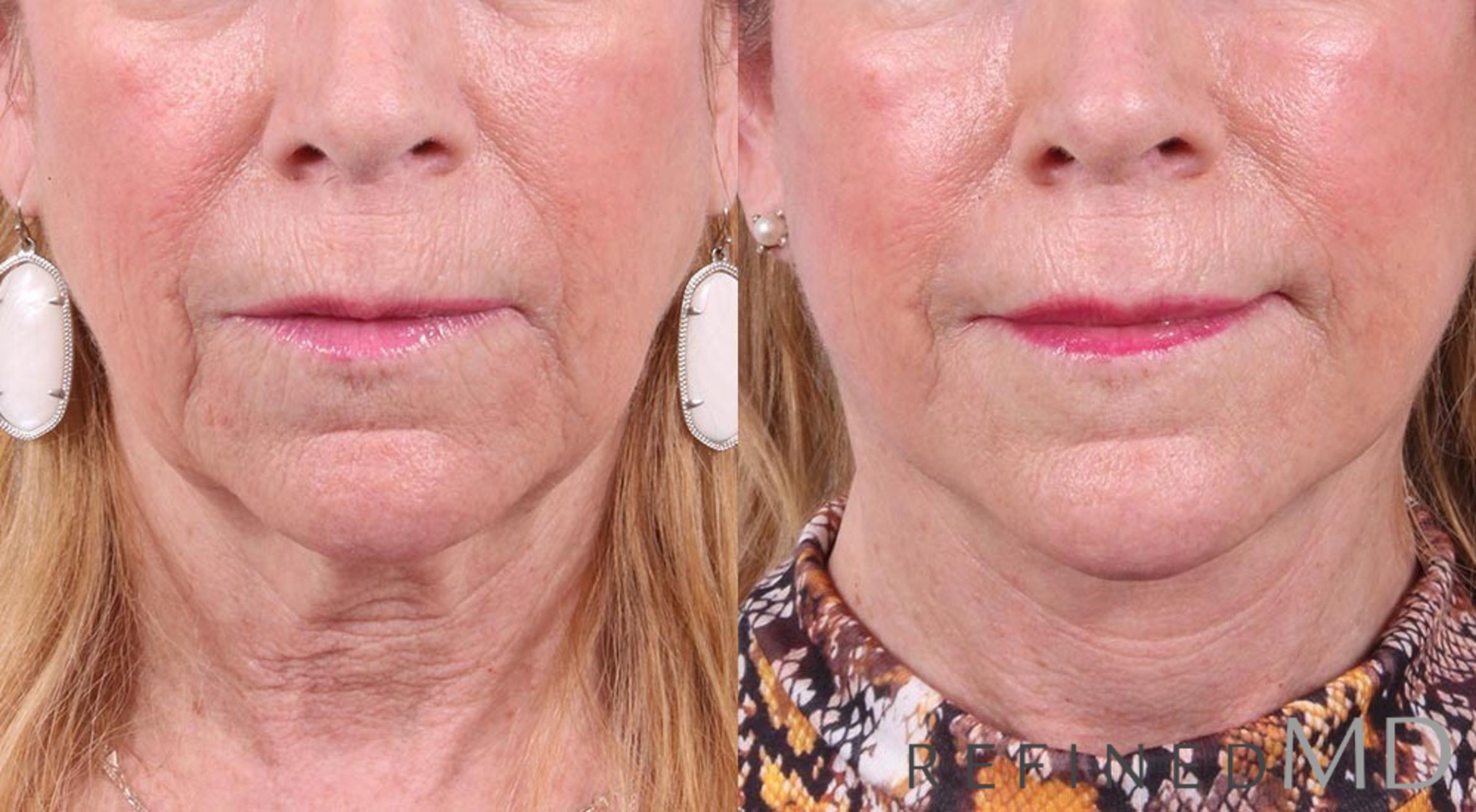 Before & After Facelift Case 1014 View 1 View in Los Gatos & San Jose, CA