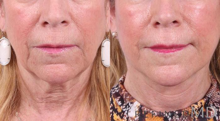 Before & After Facelift Case 1014 View 1 View in Los Gatos & San Jose, CA