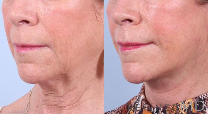 Before & After Facelift Case 1014 View 2 View in Los Gatos & San Jose, CA