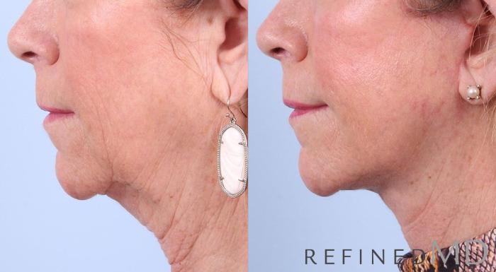 Before & After Facelift Case 1014 View 3 View in Los Gatos & San Jose, CA