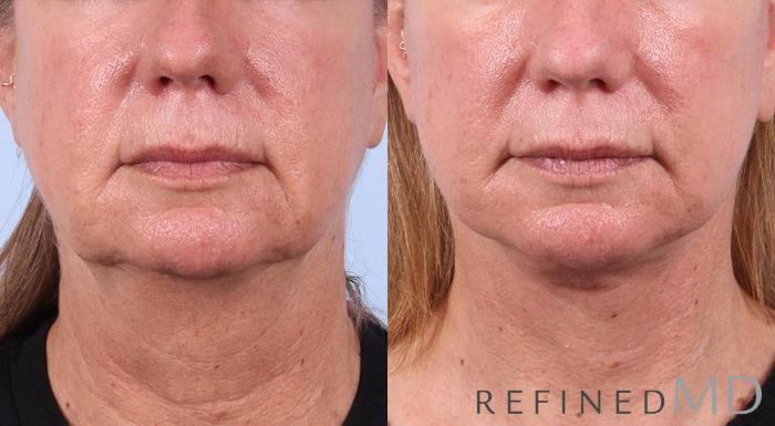 Before & After Facelift Case 1015 View 1 View in Los Gatos & San Jose, CA