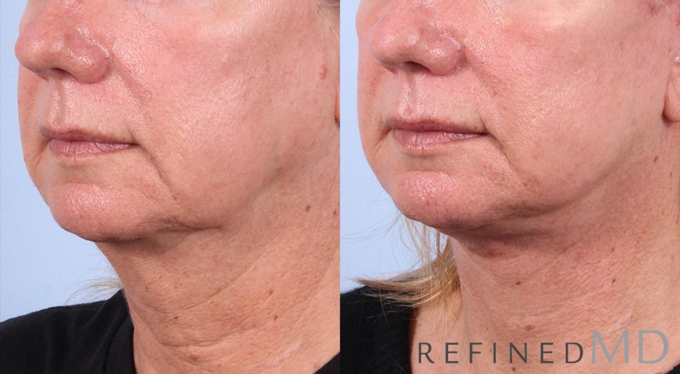 Before & After Facelift Case 1015 View 2 View in Los Gatos & San Jose, CA