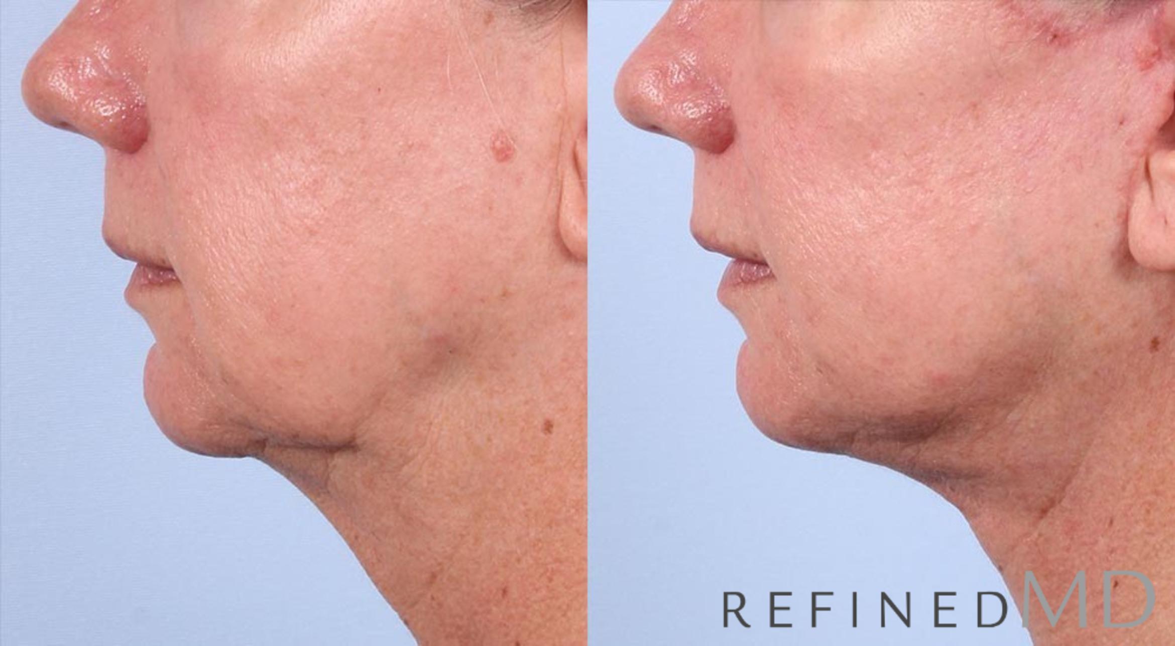 Before & After Facelift Case 1015 View 3 View in Los Gatos & San Jose, CA