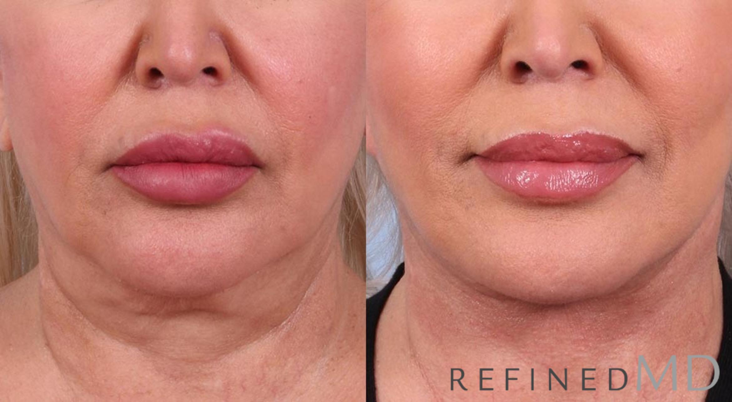 Before & After Facelift Case 1016 View 1 View in Los Gatos & San Jose, CA