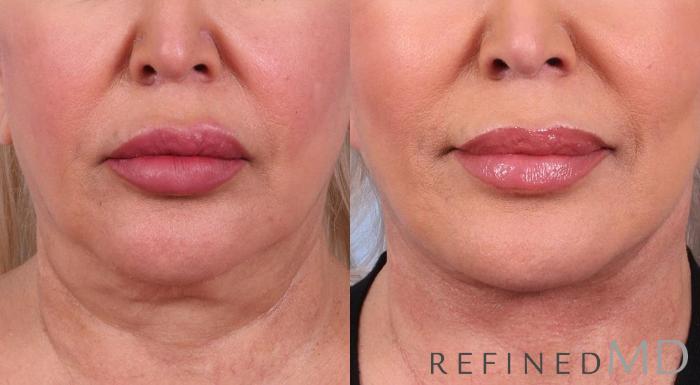 Before & After Facelift Case 1016 View 1 View in Los Gatos & San Jose, CA