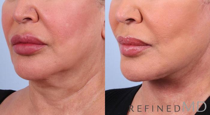 Before & After Facelift Case 1016 View 2 View in Los Gatos & San Jose, CA