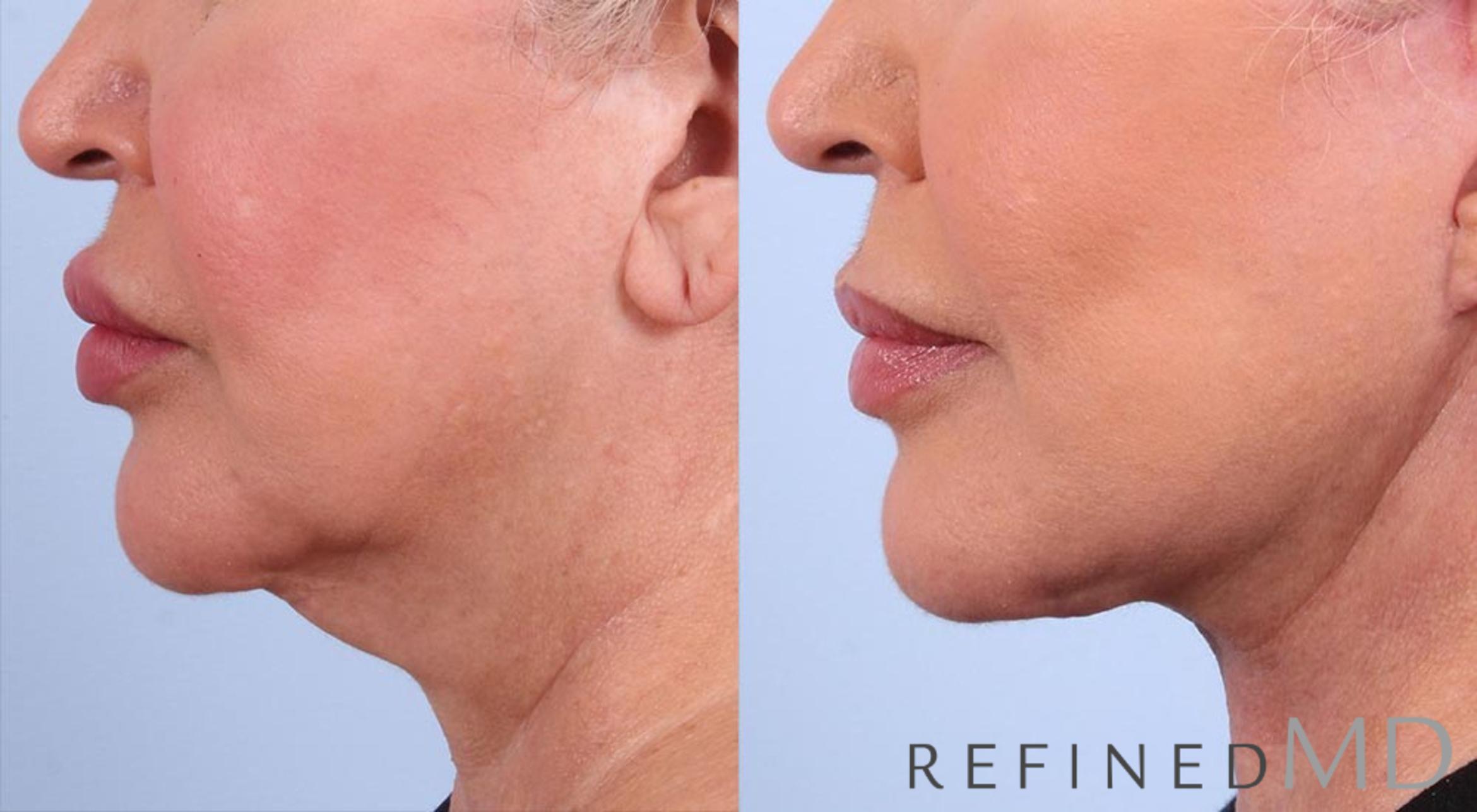 Before & After Facelift Case 1016 View 3 View in Los Gatos & San Jose, CA
