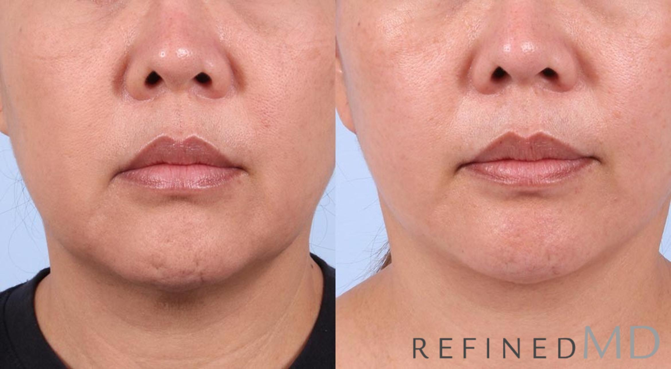 Before & After Facelift Case 1017 View 1 View in Los Gatos & San Jose, CA