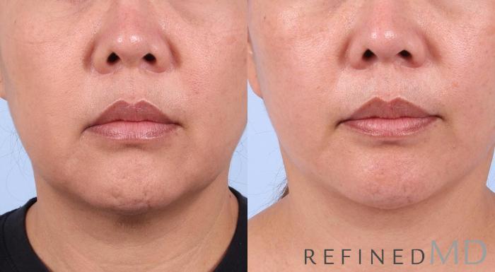 Before & After Facelift Case 1017 View 1 View in Los Gatos & San Jose, CA
