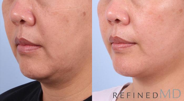 Before & After Facelift Case 1017 View 2 View in Los Gatos & San Jose, CA