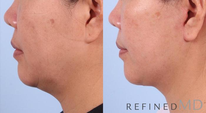 Before & After Facelift Case 1017 View 3 View in Los Gatos & San Jose, CA
