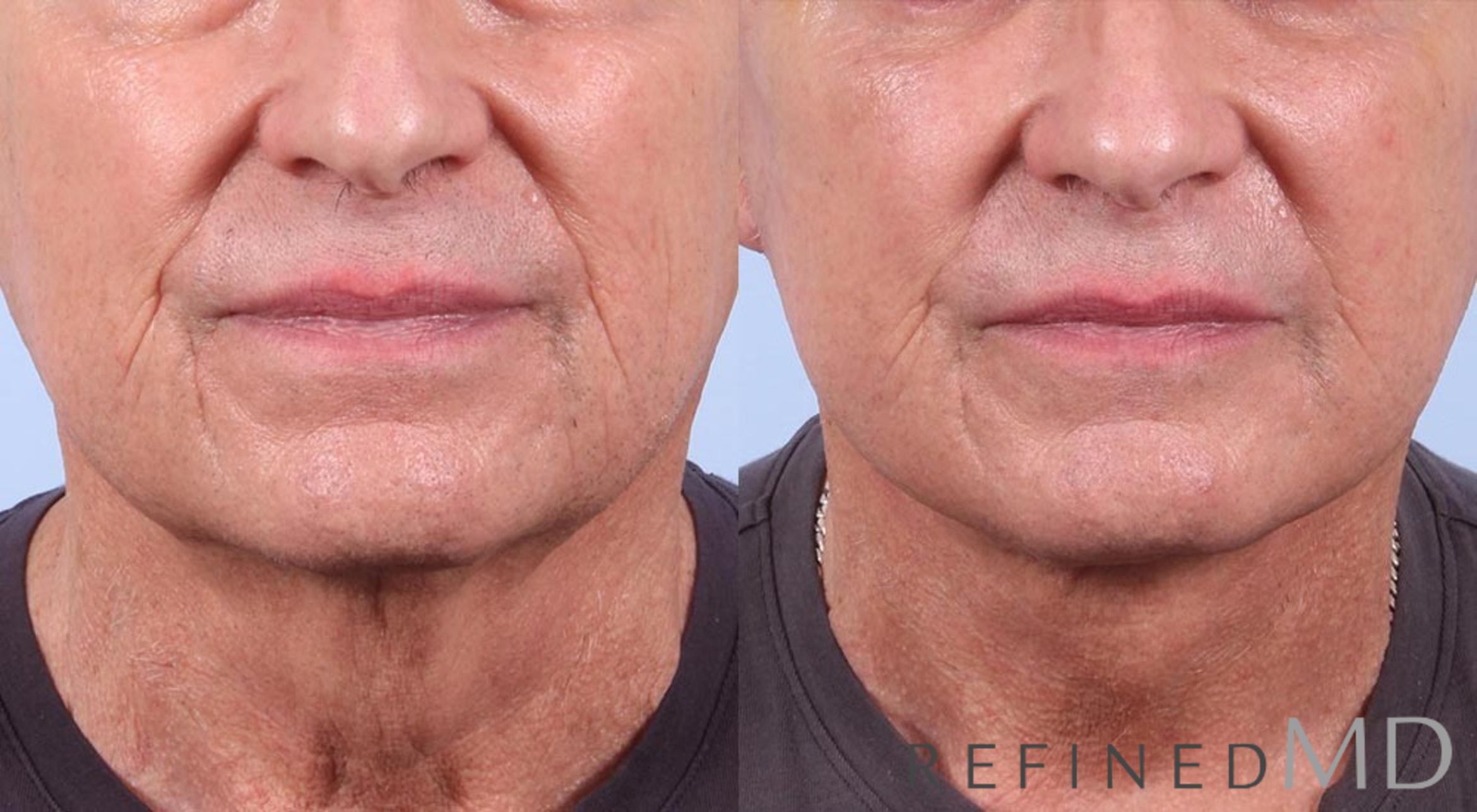 Before & After Facelift Case 1018 View 1 View in Los Gatos & San Jose, CA