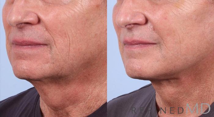 Before & After Facelift Case 1018 View 2 View in Los Gatos & San Jose, CA