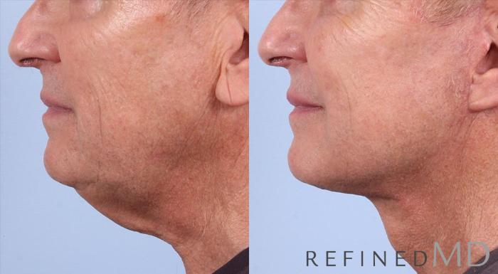 Before & After Facelift Case 1018 View 3 View in Los Gatos & San Jose, CA