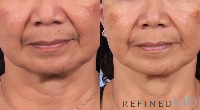 Before & After Facelift Case 1019 View 1 View in Los Gatos & San Jose, CA
