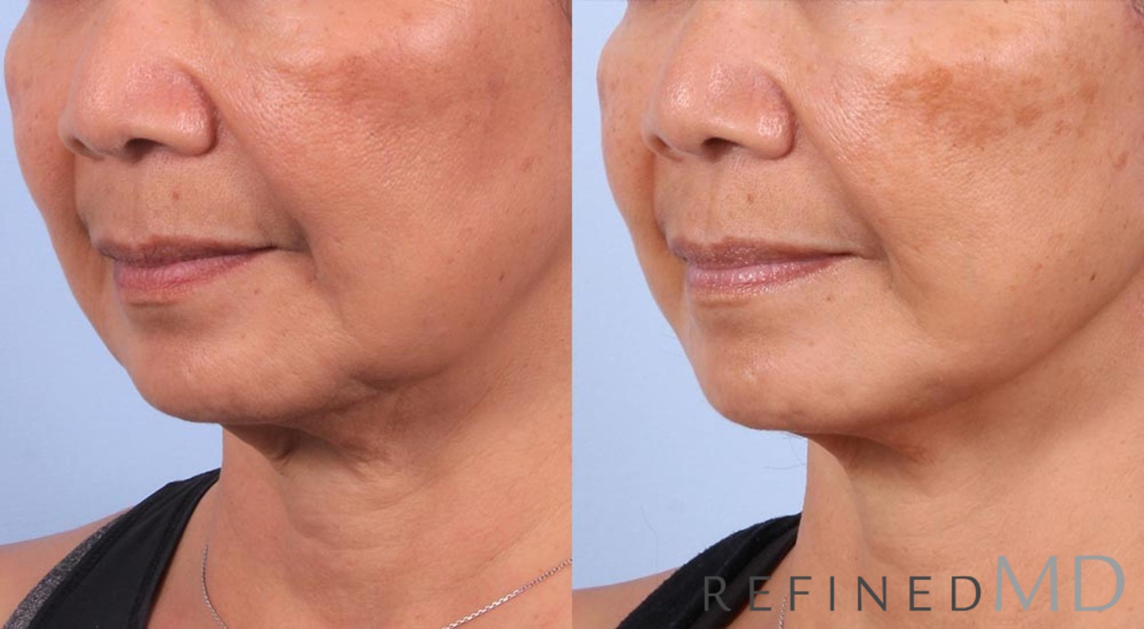 Before & After Facelift Case 1019 View 2 View in Los Gatos & San Jose, CA