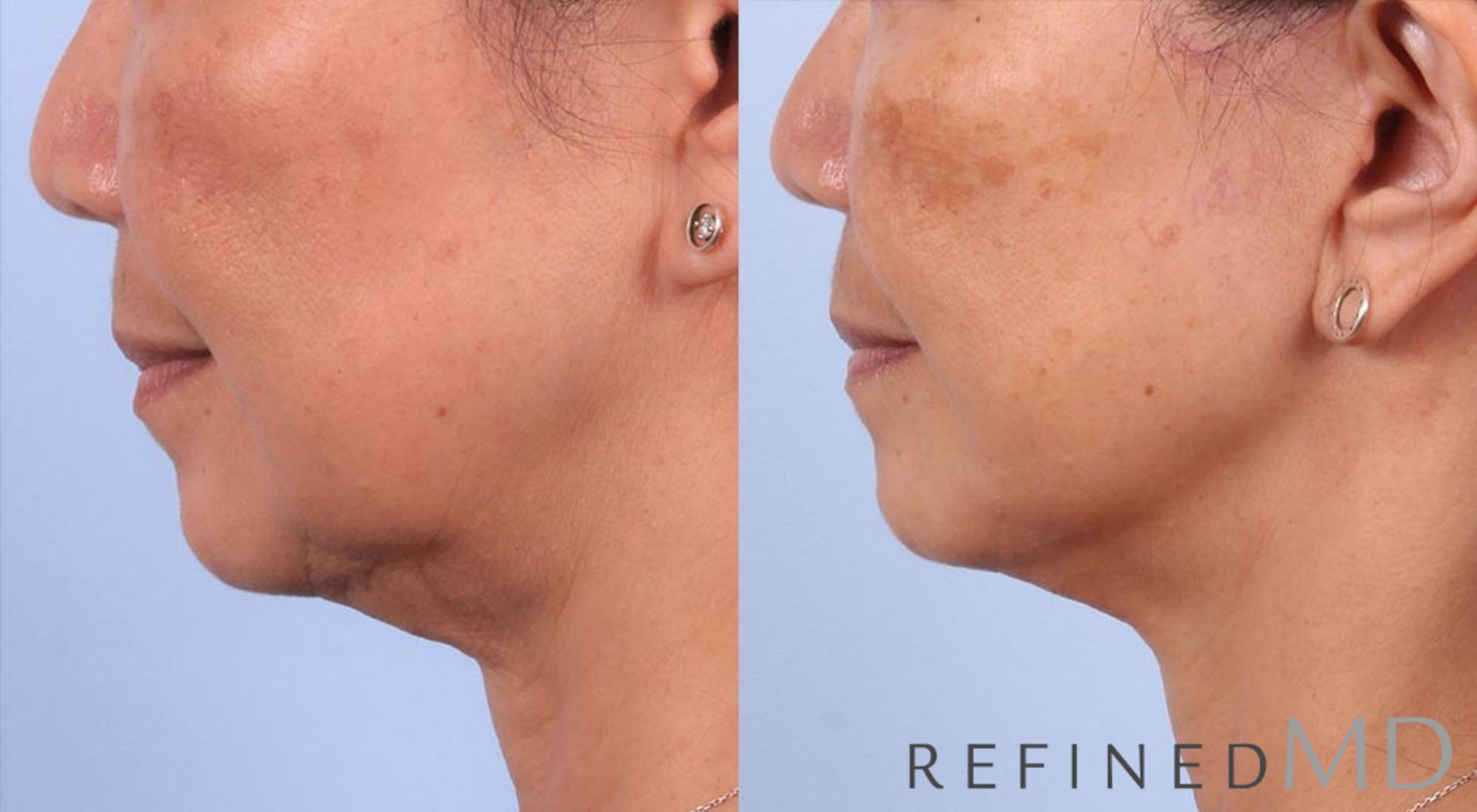 Before & After Facelift Case 1019 View 3 View in Los Gatos & San Jose, CA