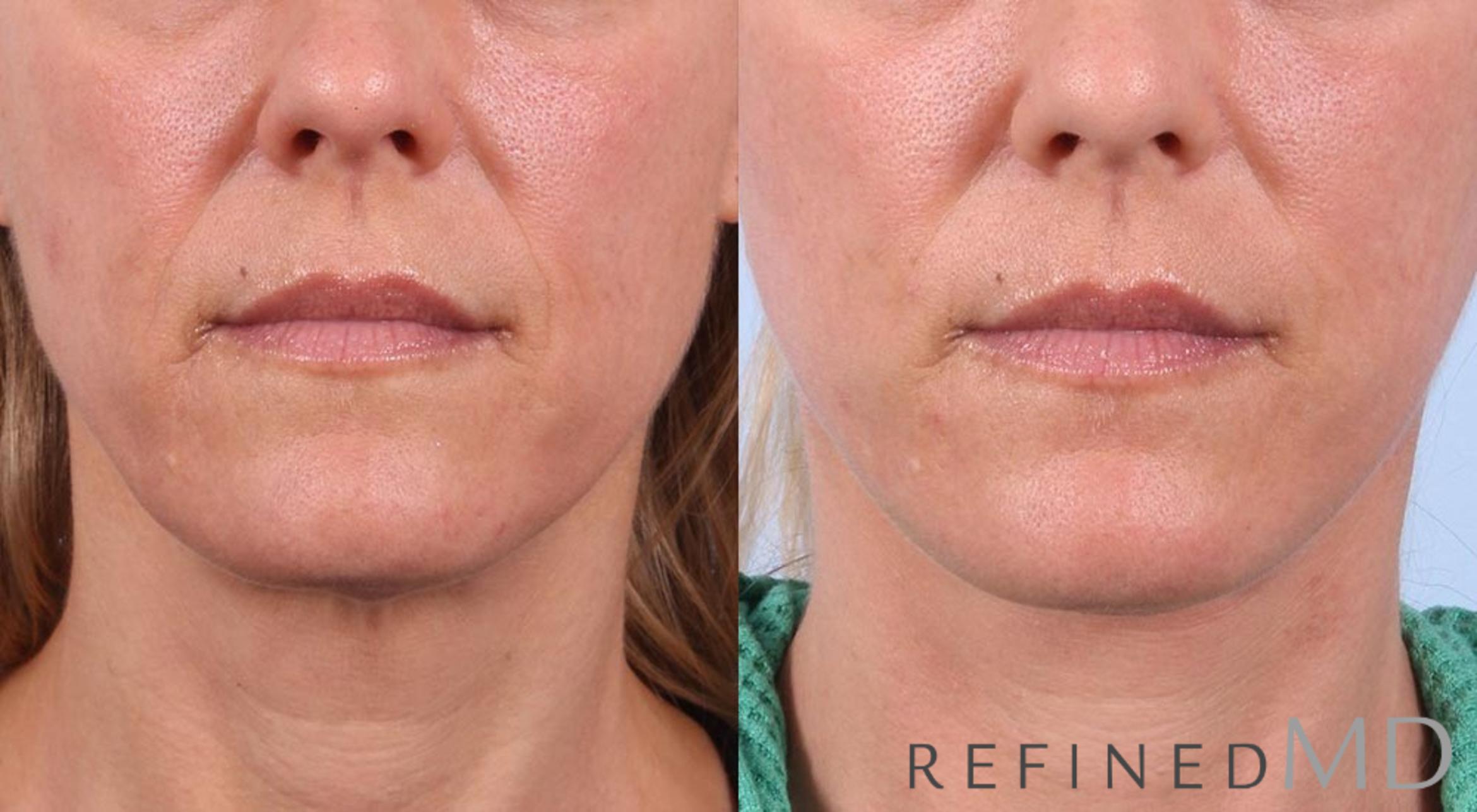 Before & After Facelift Case 1020 View 1 View in Los Gatos & San Jose, CA