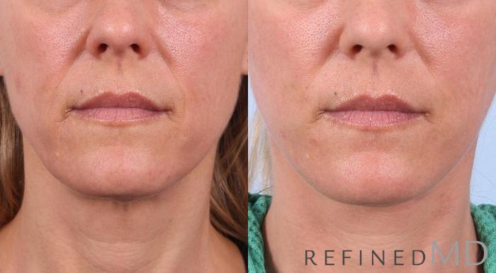 Before & After Facelift Case 1020 View 1 View in Los Gatos & San Jose, CA
