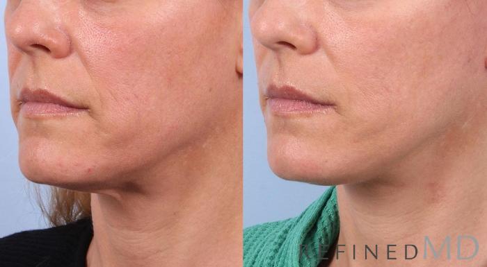 Before & After Facelift Case 1020 View 2 View in Los Gatos & San Jose, CA