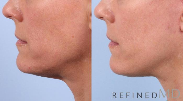 Before & After Facelift Case 1020 View 3 View in Los Gatos & San Jose, CA