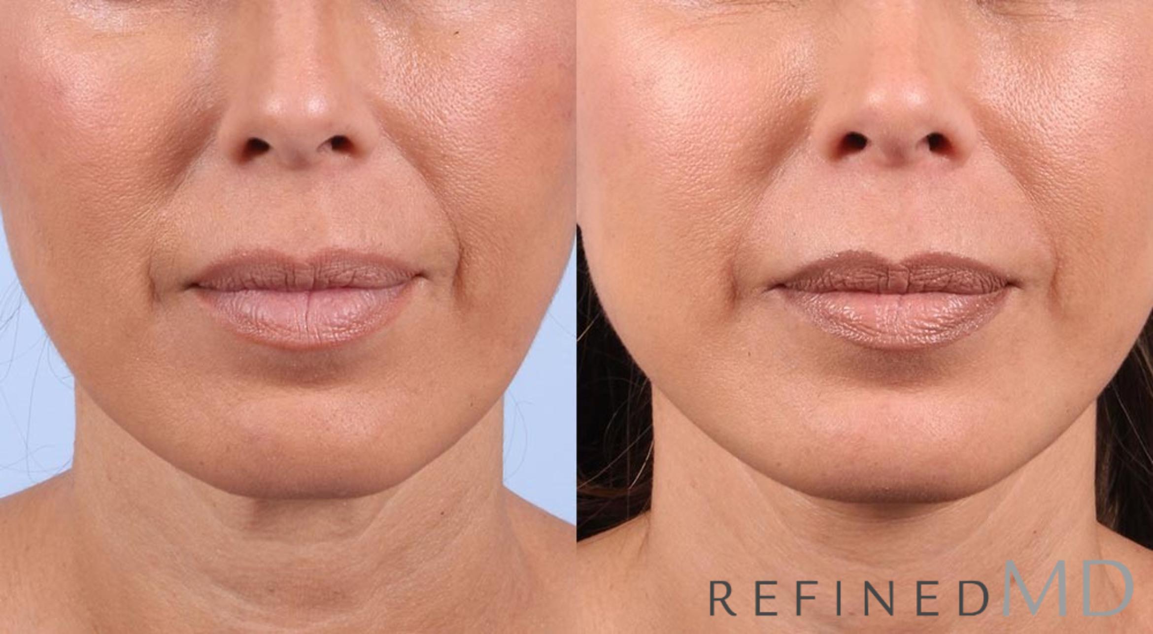 Before & After Facelift Case 1021 View 1 View in Los Gatos & San Jose, CA