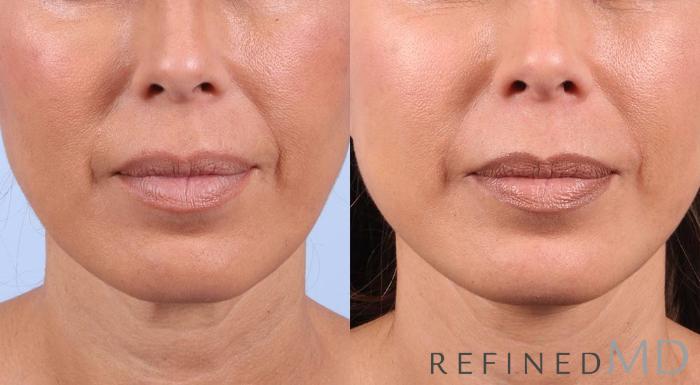 Before & After Facelift Case 1021 View 1 View in Los Gatos & San Jose, CA