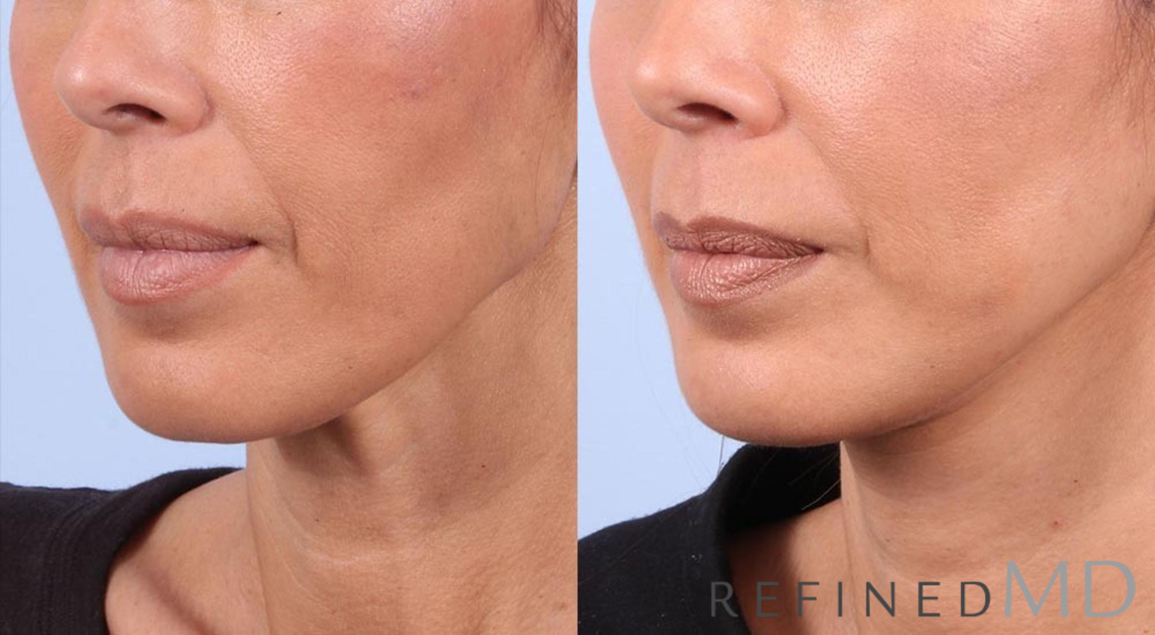 Before & After Facelift Case 1021 View 2 View in Los Gatos & San Jose, CA
