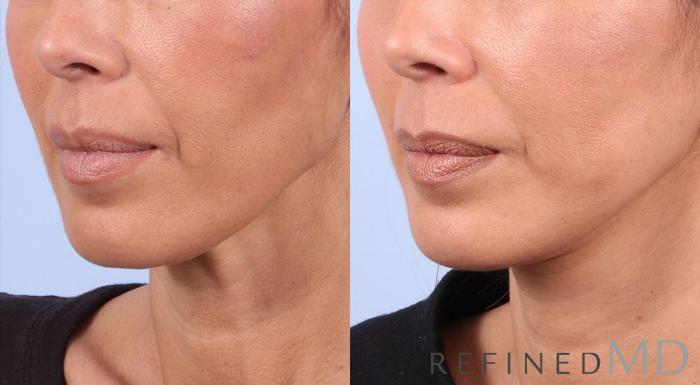 Before & After Facelift Case 1021 View 2 View in Los Gatos & San Jose, CA
