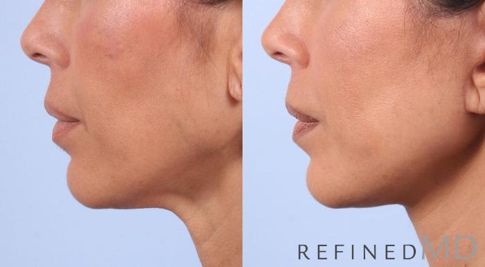 Before & After Facelift Case 1021 View 3 View in Los Gatos & San Jose, CA