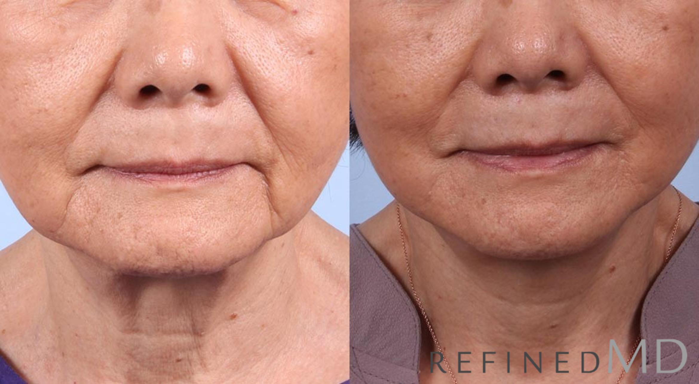 Before & After Facelift Case 1022 View 1 View in Los Gatos & San Jose, CA