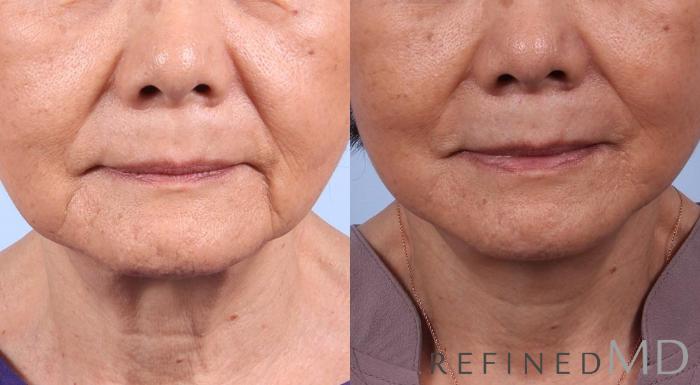 Before & After Facelift Case 1022 View 1 View in Los Gatos & San Jose, CA