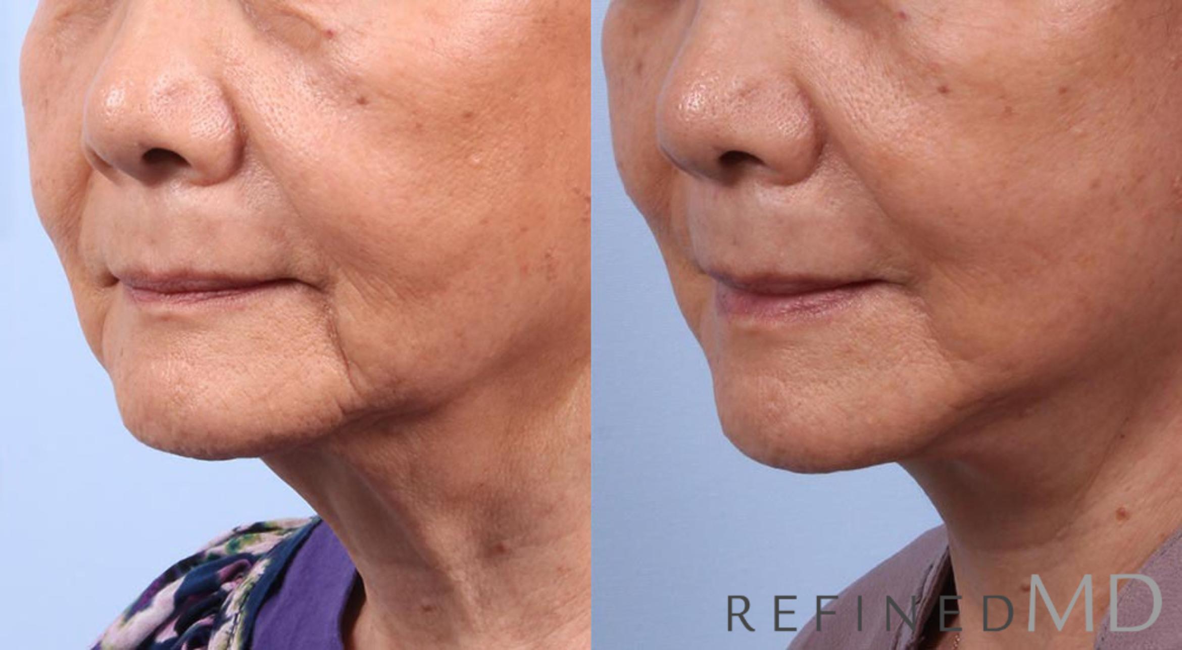 Before & After Facelift Case 1022 View 2 View in Los Gatos & San Jose, CA