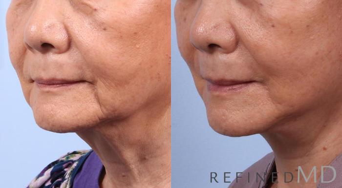 Before & After Facelift Case 1022 View 2 View in Los Gatos & San Jose, CA