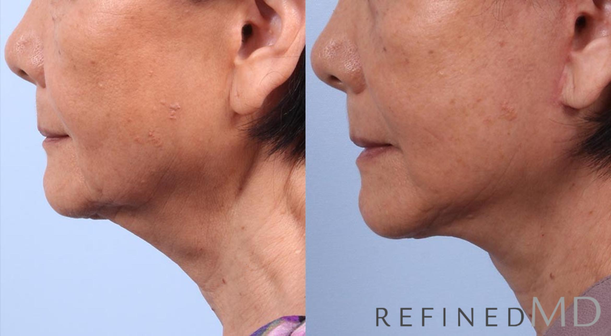Before & After Facelift Case 1022 View 3 View in Los Gatos & San Jose, CA