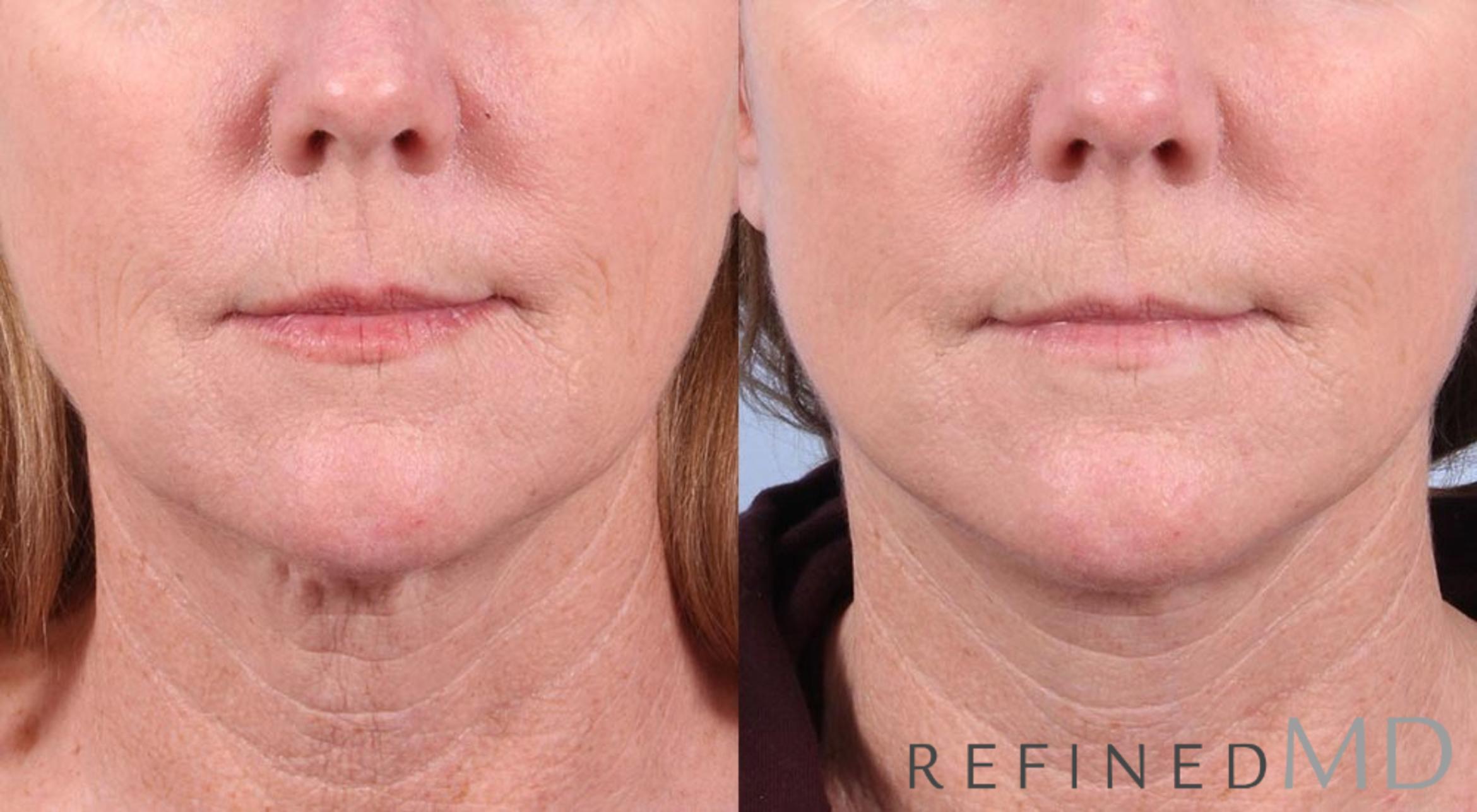 Before & After Facelift Case 1023 View 1 View in Los Gatos & San Jose, CA