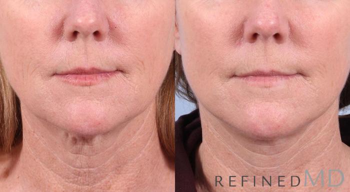 Before & After Facelift Case 1023 View 1 View in Los Gatos & San Jose, CA
