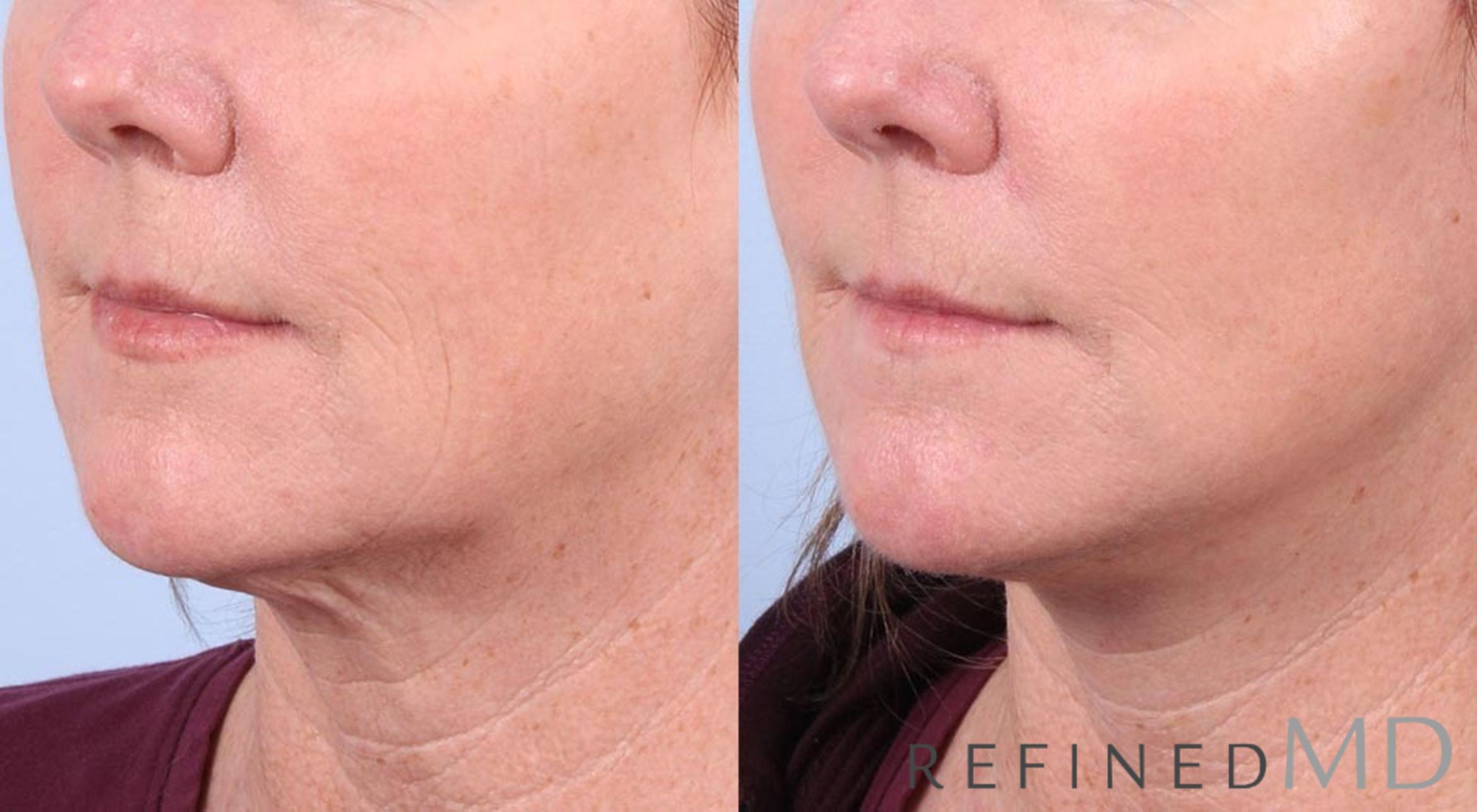 Before & After Facelift Case 1023 View 2 View in Los Gatos & San Jose, CA