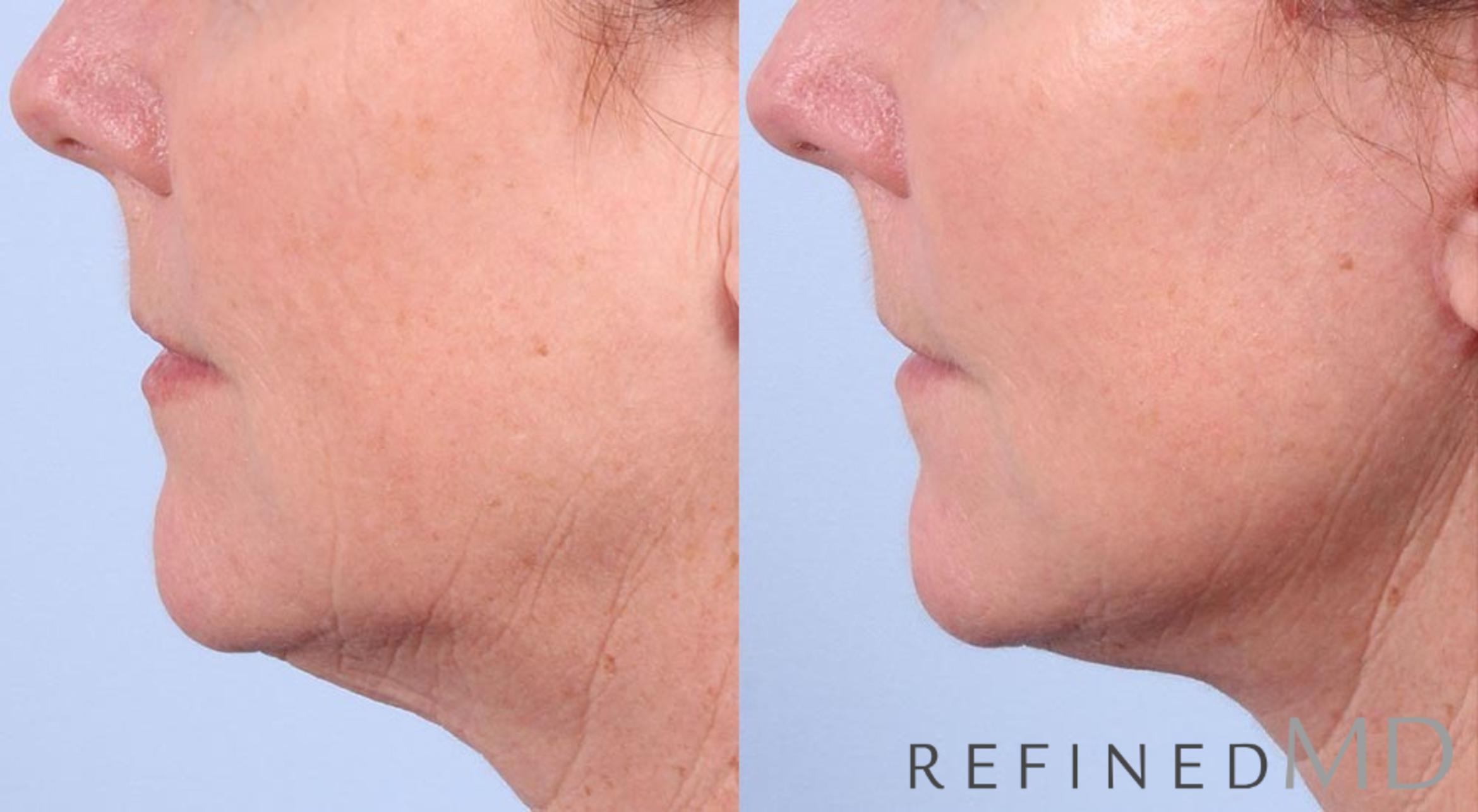 Before & After Facelift Case 1023 View 3 View in Los Gatos & San Jose, CA