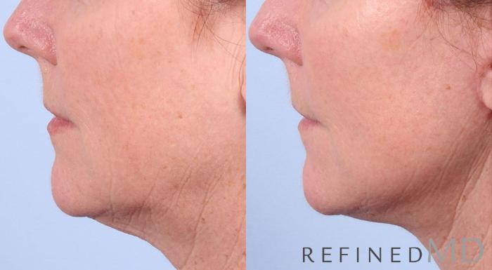 Before & After Facelift Case 1023 View 3 View in Los Gatos & San Jose, CA