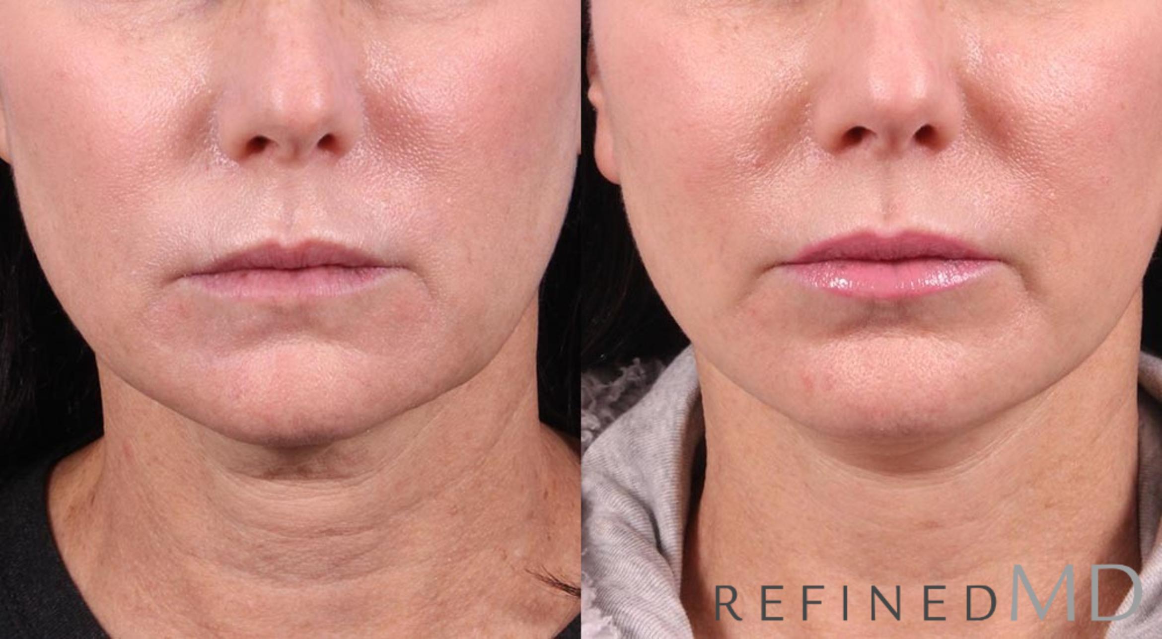 Before & After Facelift Case 1024 View 1 View in Los Gatos & San Jose, CA