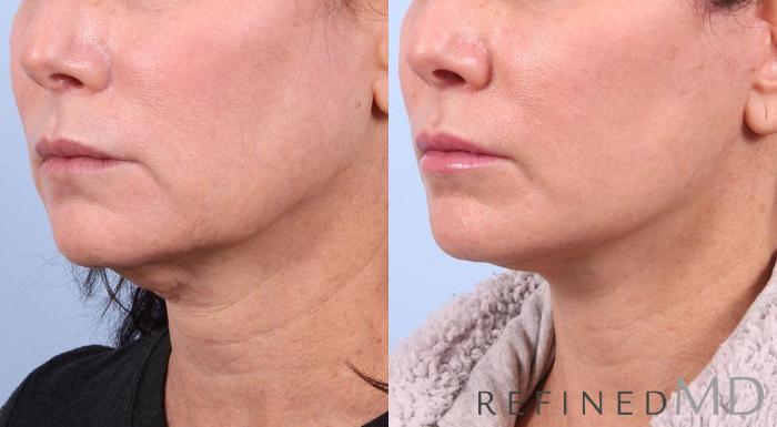 Before & After Facelift Case 1024 View 2 View in Los Gatos & San Jose, CA