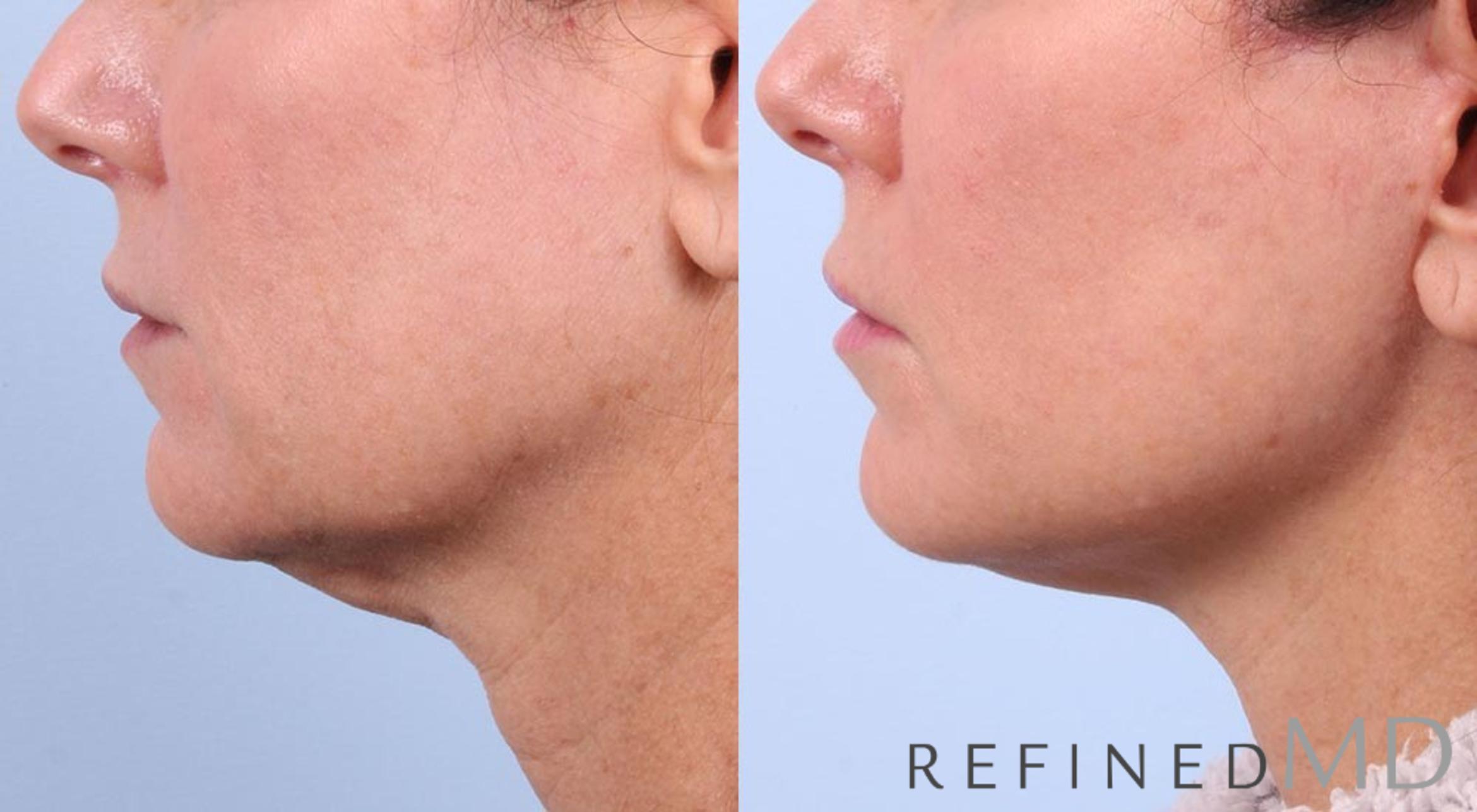 Before & After Facelift Case 1024 View 3 View in Los Gatos & San Jose, CA