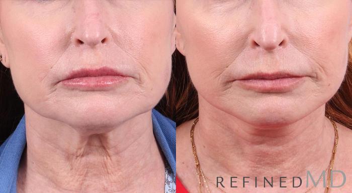 Before & After Facelift Case 1025 View 1 View in Los Gatos & San Jose, CA